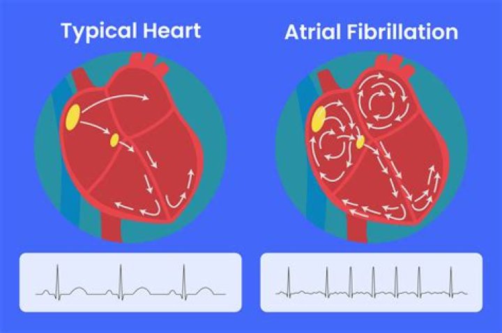 What is the difference between atrial flutter ablation and atrial fibrillation ablation?