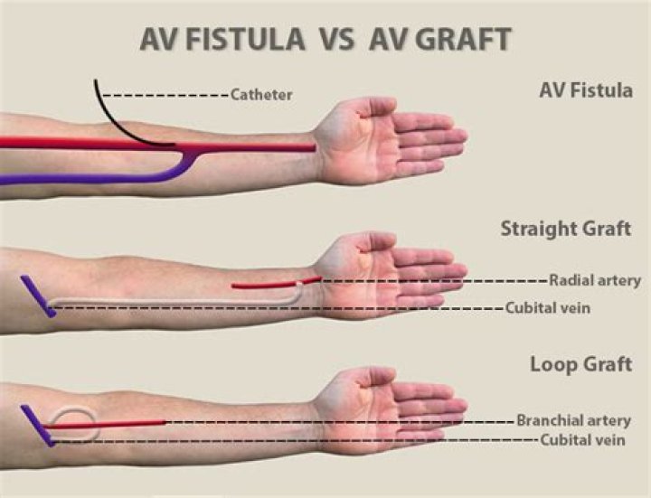 What is the difference between AV fistula and shunt?