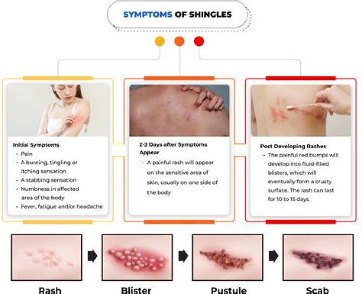 What is the early treatment for shingles?