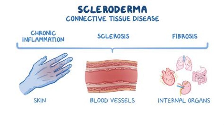 What is the life expectancy of someone with systemic scleroderma?