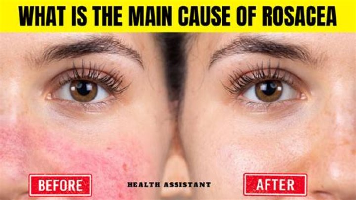What is the main cause of rosacea?