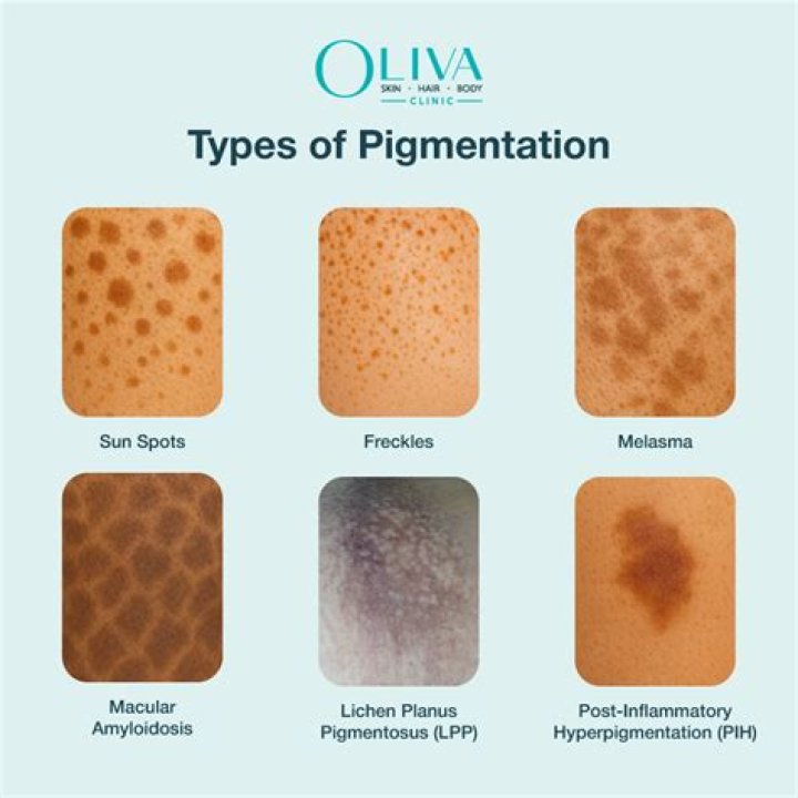What is the pigmented part of your eye?
