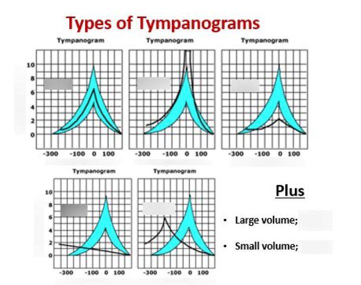 What is tympanogram compliance?