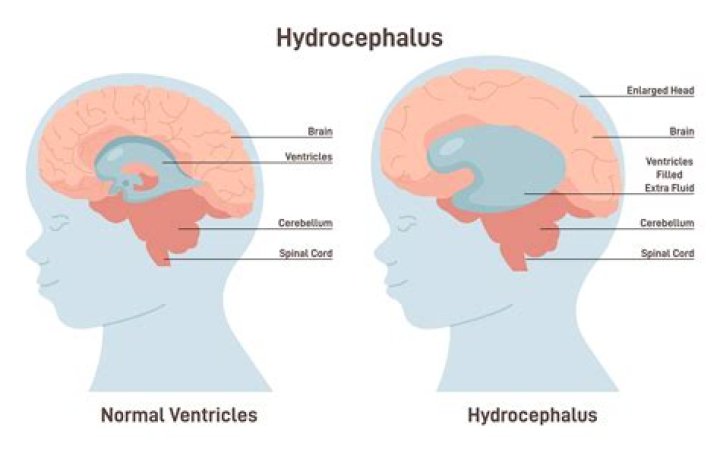 What kind of MRI is used for hydrocephalus?