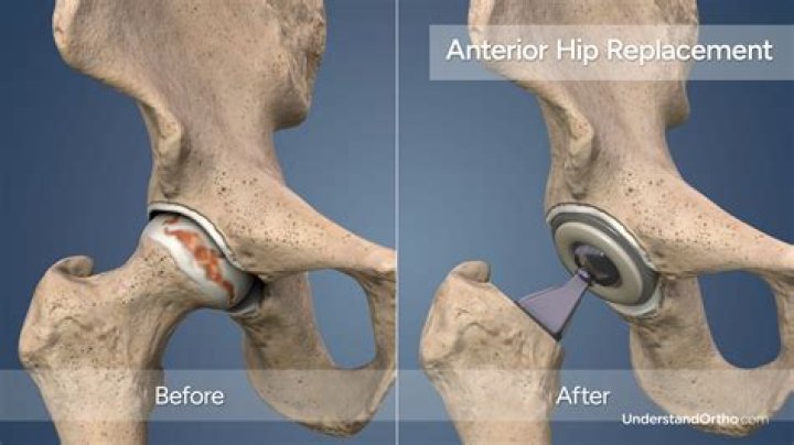 What position are you in for hip replacement?