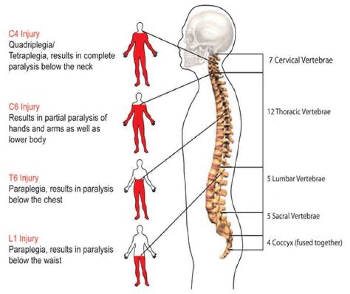 What spinal cord injury causes paraplegia?