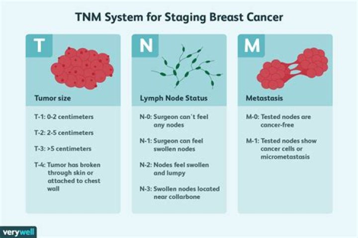 What stage is a 5 cm breast tumor?