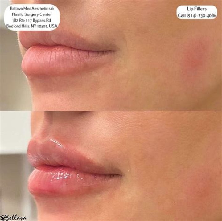 What to put on lip after waxing?