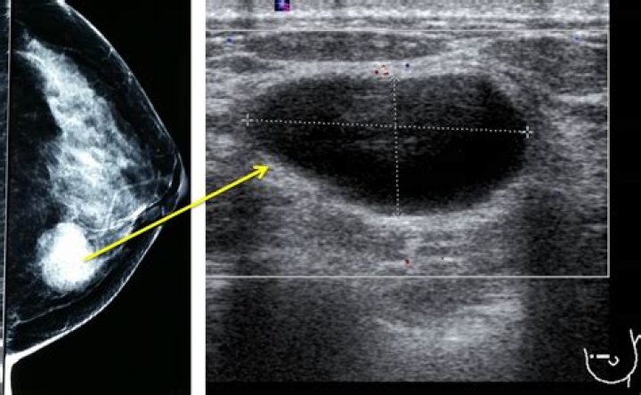 Where are breast cysts usually located?