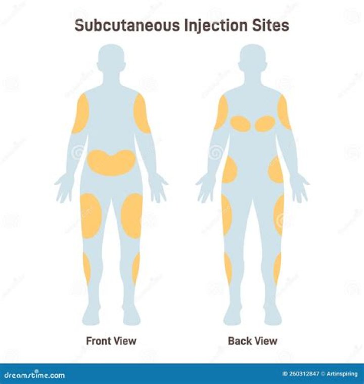 Where is a subcutaneous ICD placed?