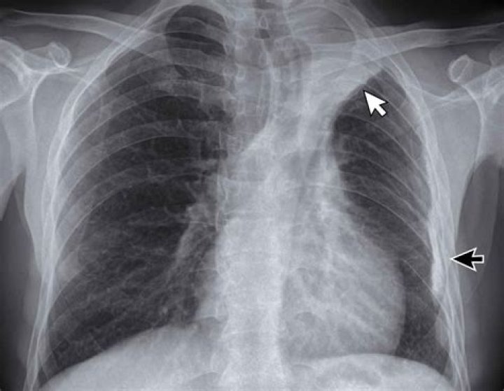 Where is the latent image in computed radiography formed?