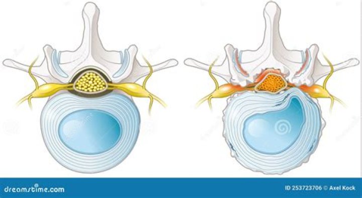 Which surgery would be performed to relieve a herniated nucleus pulposus