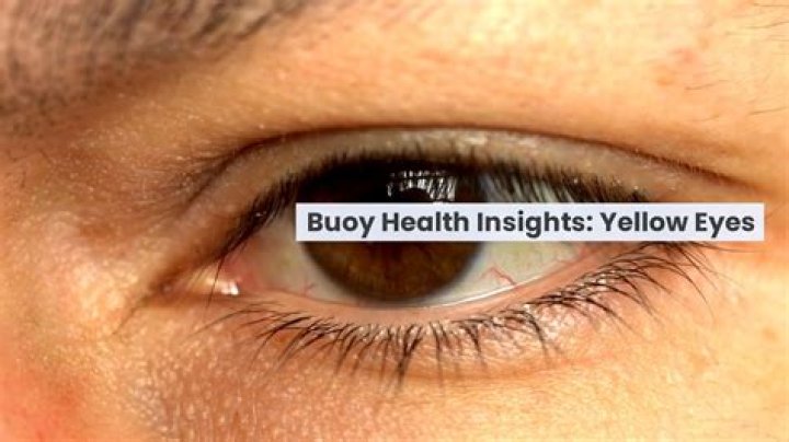 Why do I have yellow around my eyes?