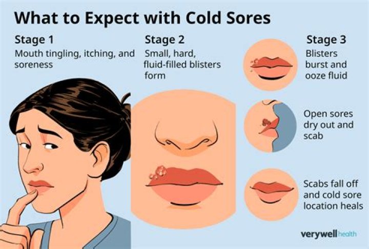 Why do I keep getting cold sores on my nose?