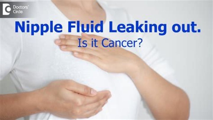 Why is my breast leaking white fluid?